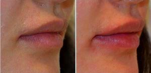 23 Year Old Female Treated For Lip Augmentation By Dr. Jason Emer, MD, Los Angeles Dermatologic Surgeon