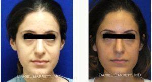 30 Year Old Woman Treated With Restylane By Doctor Daniel Barrett, MD, Beverly Hills Plastic Surgeon