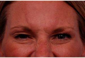 36 Year Old Woman Treated With Botox By Doctor Thomas J. Walker, MD, Atlanta Facial Plastic Surgeon