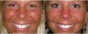 42 Year Old Woman Treated With Botox By Doctor Nancy Swartz, MS, MD, FACS, Philadelphia Oculoplastic Surgeon