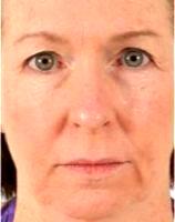 63 Year Old Woman Treated With Botox By Doctor Robert W. Sheffield, MD, Santa Barbara Plastic Surgeon
