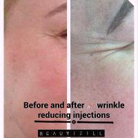 Before And After Wrinkle Reduction Injection