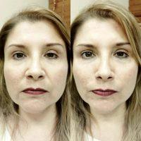 Botox And Restylane Results Are Often Very Dramatic