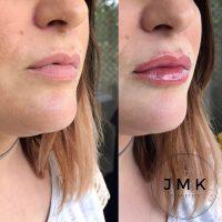 Combine Botox And Restylane In The Lips.