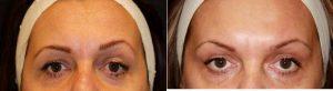 Correction Of Eyebrow Assymentry With Botox By Doctor Tatiana Khrom, MD, New York Dermatologic Surgeon