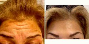 Doctor Amir Kachooei, DDS, London Dentist - 57 Year Old Woman Treated With Botox For Forehead Wrinkles