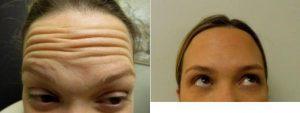 Doctor Kim Nichols, MD, Greenwich Dermatologist - 34 Year Old Female Treated With Botox For Frown (brow), Forehead And Crows Feet Lines And Wrinkles
