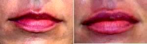 Doctor Richard G. Reish, MD, FACS, New York Plastic Surgeon - 23 Year Old Woman Treated With Juvederm