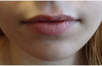 Dr Deborah Marciano, DO, Great Neck Physician - 24 Year Old Woman Treated With Restylane