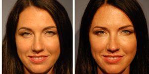 Dr Harry V. Wright, MD, Sarasota Facial Plastic Surgeon - 42 Year Old Woman Treated With Restylane For Rejuvenation Of The Lower Eyelids