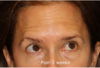 Dr. Douglas Wu, MD, San Diego Dermatologist - 38 Year Old Woman Treated With Botox