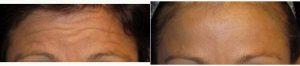 Dr. Raymond E. Lee, MD, Orange County Facial Plastic Surgeon - 38 Year Old Woman Treated With Botox For Forehead Wrinkles