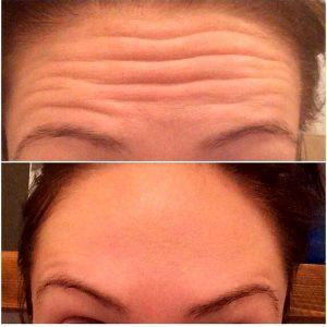 Forehead Wrinkles Botox Photos (2)