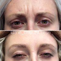 Selective Placement Of Botox For Brow Lift