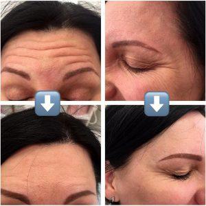 Wrinkles In Forehead Botox Before And After Pics (2)