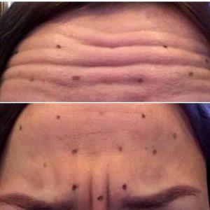 botox before after pictures forehead wrinkles (1)