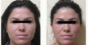 25 Year Old Woman Treated With Preventative Botox By Dr Elham Jafari, MD, Irvine Physician