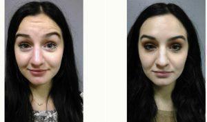 27 Year Old Woman Treated With Botox