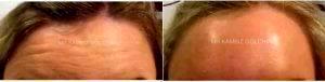 34 Year Old Woman Treated With BOTOX Horizontal Lines By Dr Kambiz Golchin, MBBS, FRCS (Eng), FRCS(ORL-HNS), London Facial Plastic Surgeon