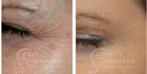 41 Year Old Woman Treated With Botox With Dr. Scott K. Thompson, MD, Salt Lake City Facial Plastic Surgeon