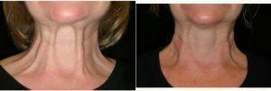 55 Year Old Woman Treated With Botox By Dr Felix Bopp, MD, New Orleans Facial Plastic Surgeon