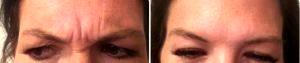 61 Year Old Woman Treated With Botox For Forehead Lines