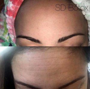 Before And After Results Performed By Dr. Roher Using Botox At SDBotox, Plastic Surgery Clinic In San Diego, California