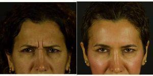 Botox 11 Lines – Preventative And Rejuvenating With Dr Kian Karimi, MD, FACS, Los Angeles Facial Plastic Surgeon