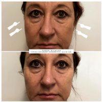 Botox And Facial Fillers Are Effective Methods Of Rectifying Signs Of Aging