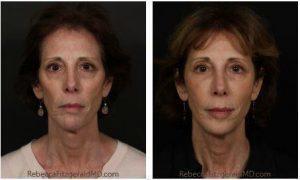 Botox And Sculptra By Dr. Rebecca Fitzgerald, Cosmetic Dermatologist In Los Angeles, Beverly Hills, Larchmont