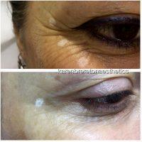 Botox Around Eyes Before And After Photos (3)