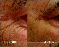 Botox Around Eyes Before And After Photos (6)
