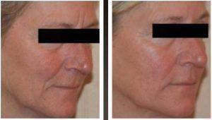 Botox Before And After By Dr. Henry G. Wells Jr, MD, Plastic Surgeon In Lexington, Kentucky (5)