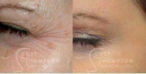 Botox Before And After Photo From Utah Facial Plastics