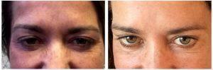 Botox Cosmetic To Treat Bunny Lines And Unde Eye Wrinkles At Laguna Beach Aesthetics