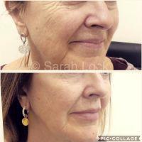 Botox Face Wrinkles Benefits Photo