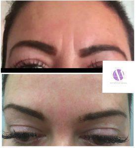 Botox For 11 Wrinkles Before And After (1)