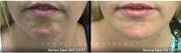 Botox For Chin Before And After (1)