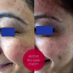 Botox For Crows Feet When Smiling