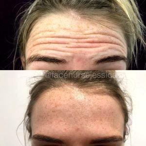 Botox For Forehead In Late 20s Before And After (1)