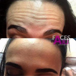 Botox For Forehead In Late 20s Before And After (7)