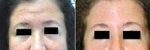 Botox For Forehead Lines With Dr Harold J. Kaplan, MD, Los Angeles Facial Plastic Surgeon