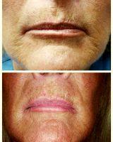 Botox For Smokers Lip Lines