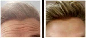 Botox Forehead Lines By Dr. Henry G. Wells Jr, MD, Plastic Surgeon In Lexington, Kentucky (2)