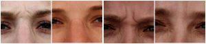 Botox Frown Lines At Lasky Aesthetics & Laser Cente, Medical Spa In Beverly Hills, California (1)