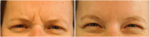 Botox Injections Between Eyebrows By Dr. Karen Horton