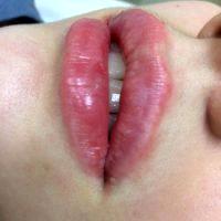 Botox Injections In Lips