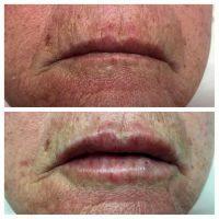 Botox Is Injected Into The Lips Using A Very Fine Needle