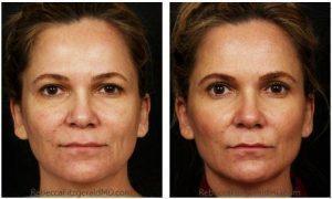 Botox, Juvederm By Dr. Rebecca Fitzgerald, Cosmetic Dermatologist In Los Angeles, Beverly Hills, Larchmont