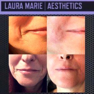 Botox Marionette Lines Before And After (4)